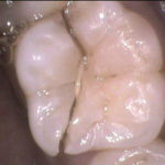 歯が割れてしまうと抜歯（歯を抜く）治療しかないのでしょうか？