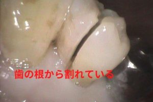 歯の根が割れている（歯根破折）の写真