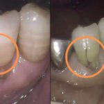 抜歯になる可能性の高い歯根破折の症状と原因とは？