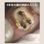 香川県 高松市の歯の神経治療｜歯の神経治療をしたところの痛みがおさまらない場合