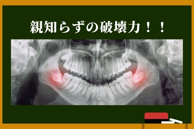 高松市で削らない虫歯治療なら薬で治す吉本歯科医院